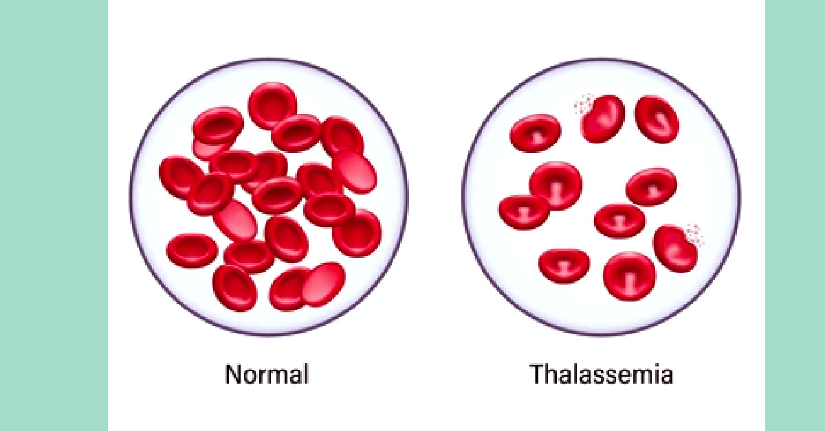থ্যালাসেমিয়া রোগী কতদিন বাঁচে